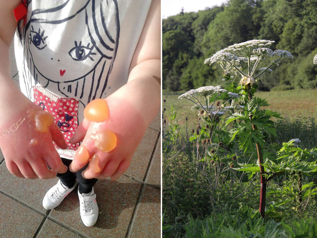 hogweed blisters